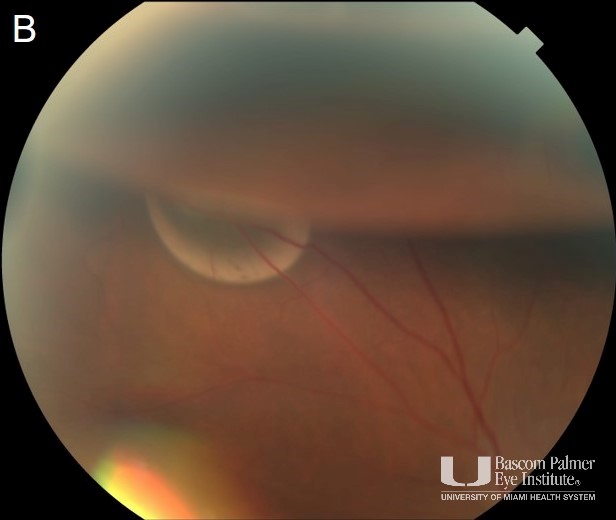 Course SubRetinal Gas Post Pneumatic Retinopexy Managed with Observation